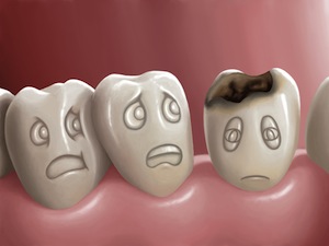 Not All Cavities Are The Same—Know The Different Types