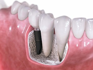 If You’re Missing Teeth, We Can Help!