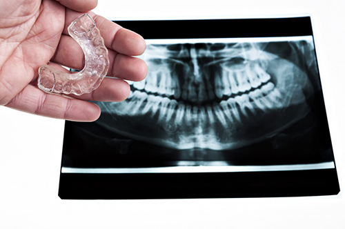Bruxism: Stop grinding those pearly whites!