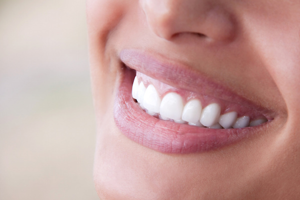 Veneers or Crowns: Which is Right for You?